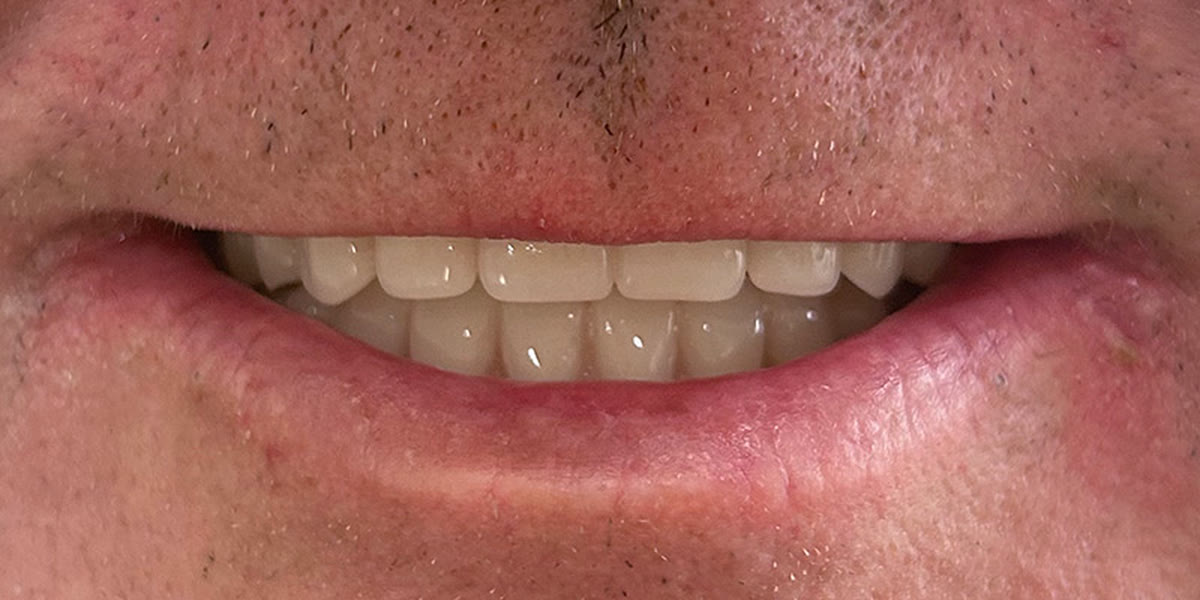 One of our cases after the denture was fitted
