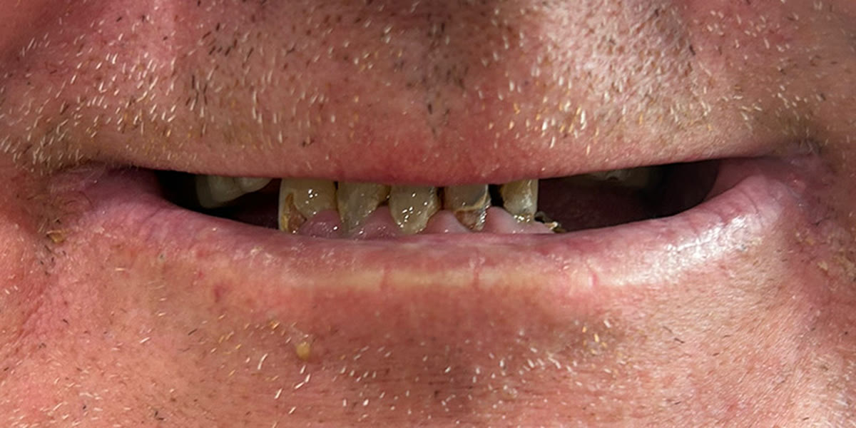The same case before treatment