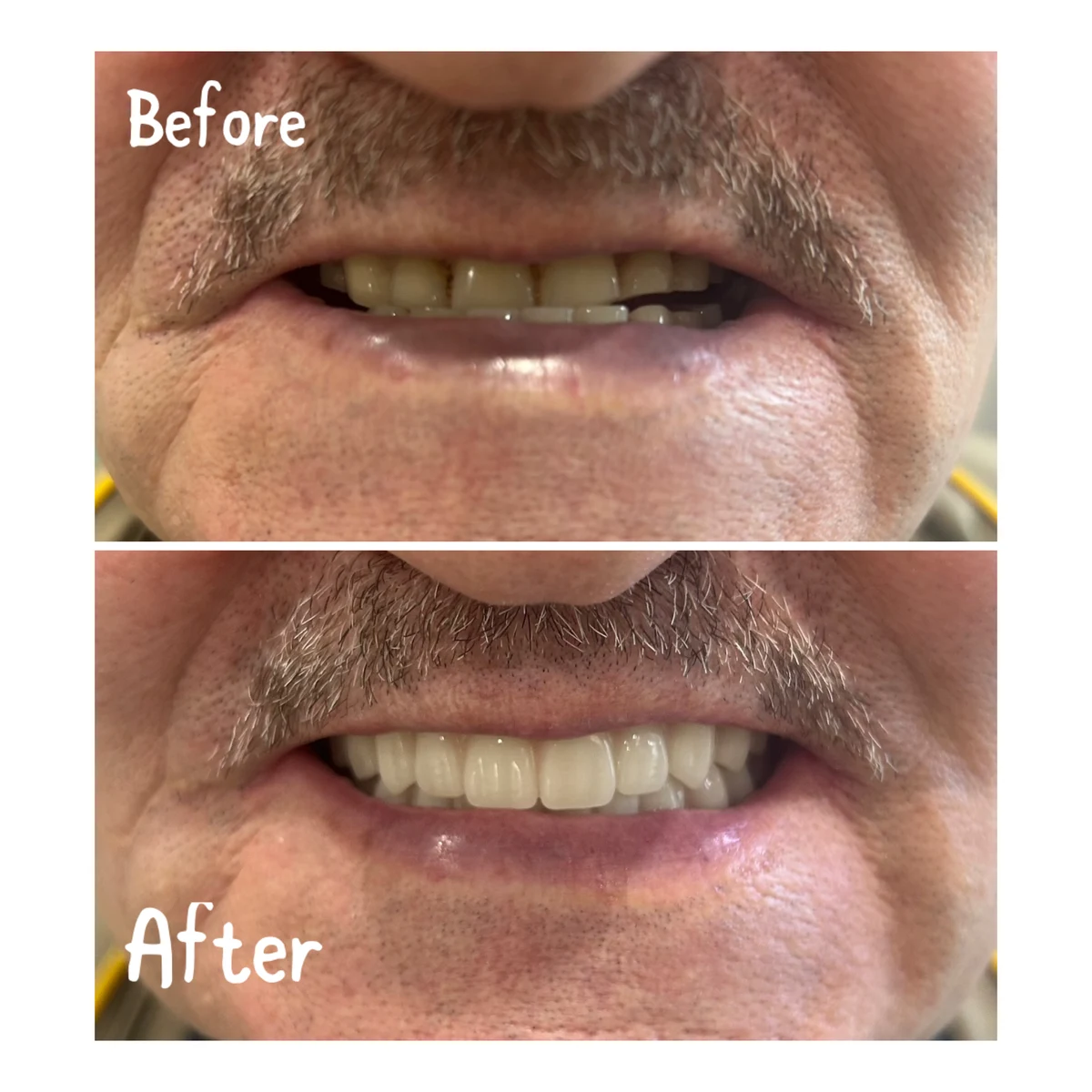 Denture case 1: before above and after below