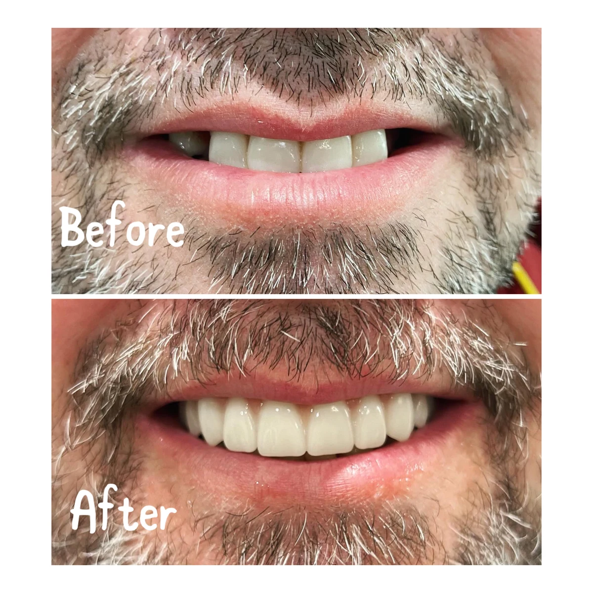 Denture case 2: before above and after below