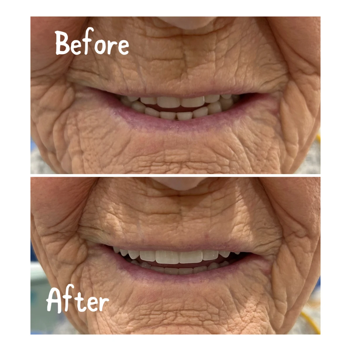 Denture case 3: before above and after below