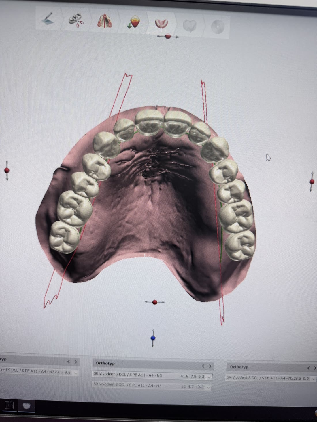 A denture being designed on screen, with the upper and lower arches positioned against each other