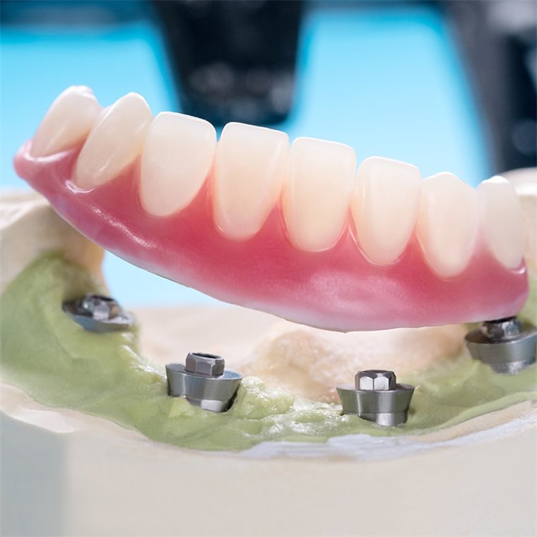 A denture showing implant locator attachments in its fitting surface