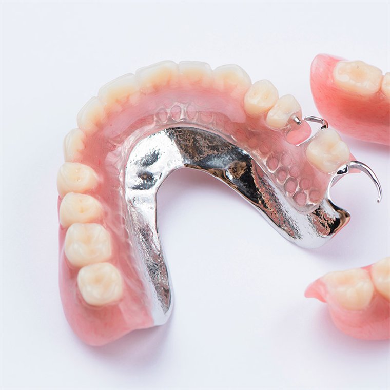 A cast cobalt chrome partial denture framework with clasps